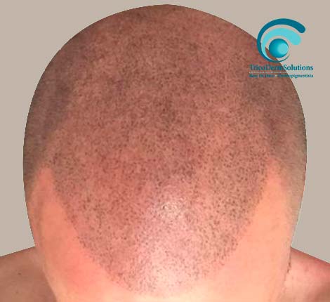 Vieni a scoprire i particolari. Tricopigmentazione Micropigmentazione Capelli Tricodermsolutions