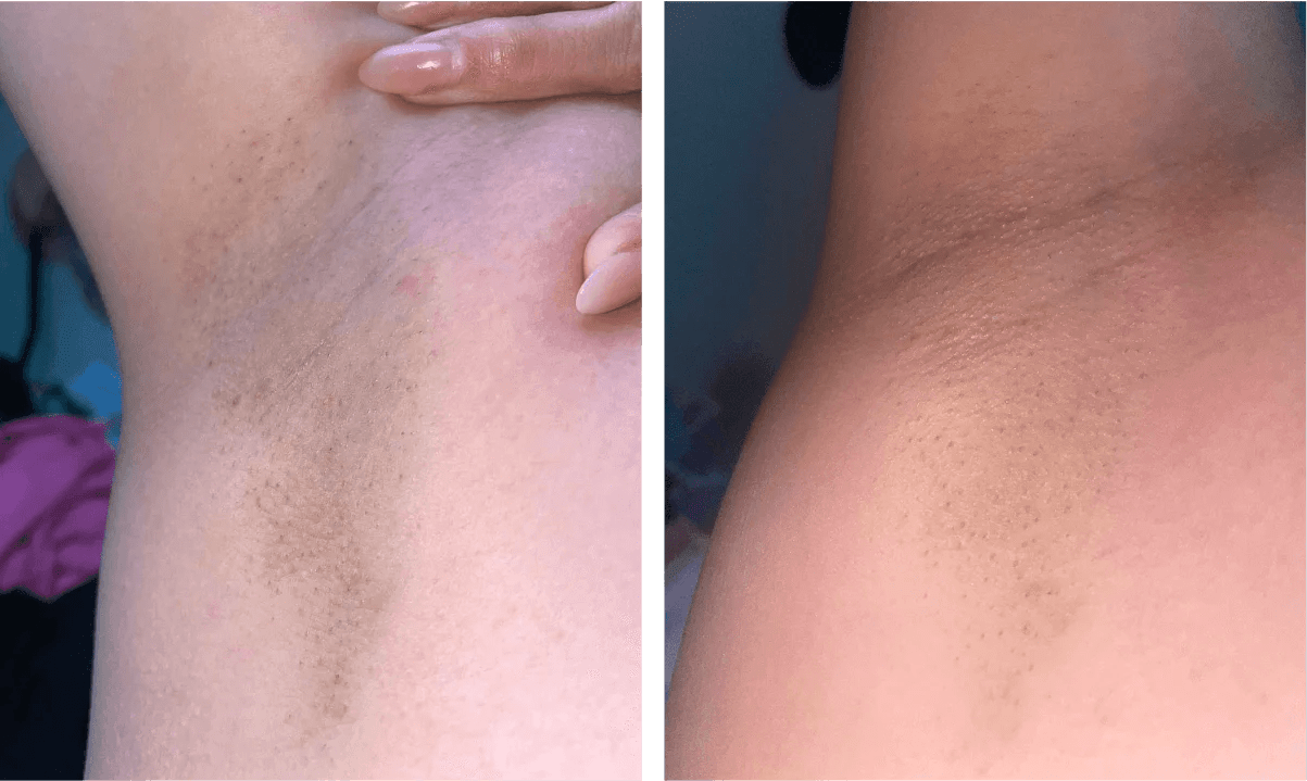 Ulike Air 10 Ipl Laser Hair Removal Device