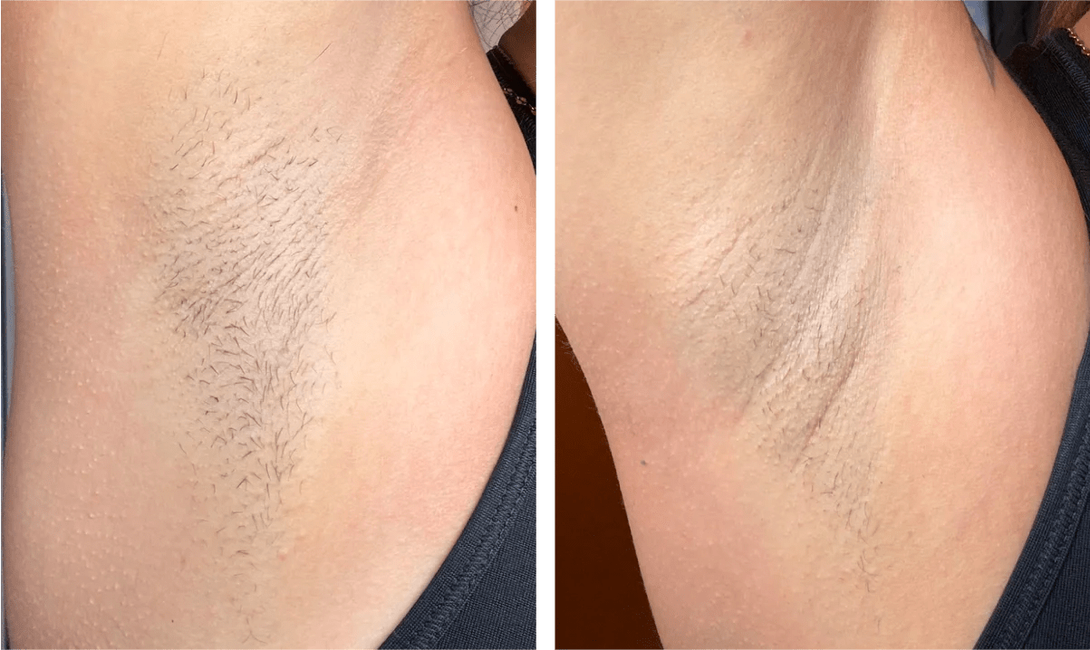 Ulike Air 10 Ipl Laser Hair Removal Device