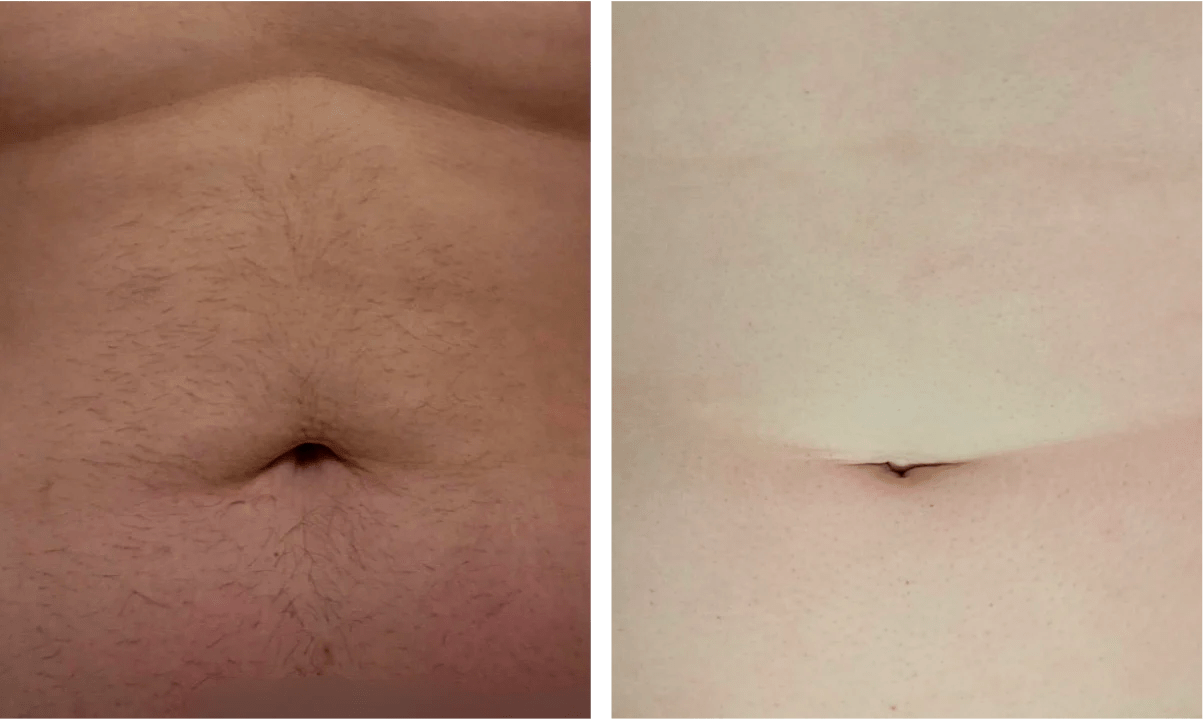 Ulike Air 10 Ipl Laser Hair Removal Device