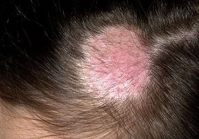 Shampoo conditioner treatment haaröl trockenshampoo. Hair Loss and Demodex Mites | Ungex | Demodex Treatment