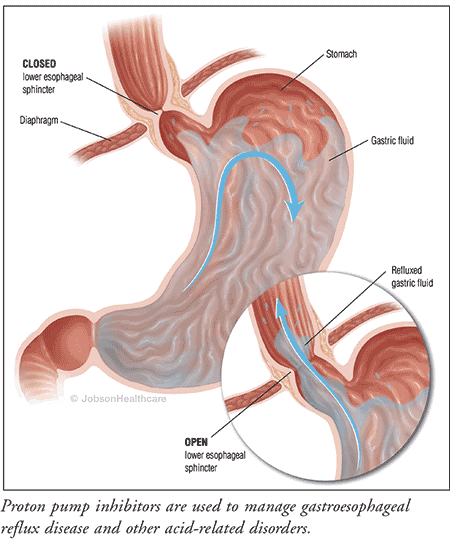 © 2022 mjh life sciences™ and pharmacy times. Proton Pump Inhibitors Considerations With Long Term Use