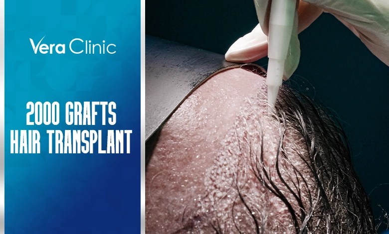 A guide to 2000 grafts hair transplant cost