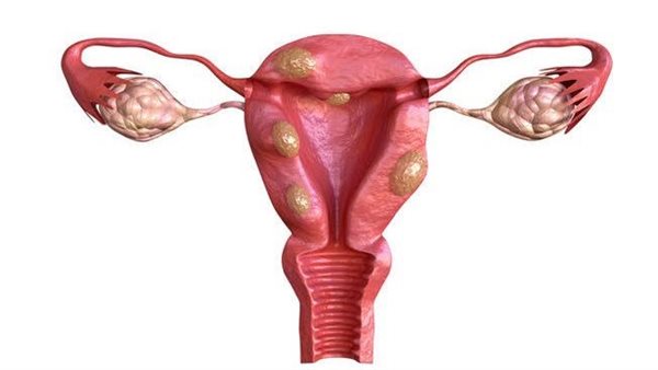 أهم أعراض بطانة الرحم المهاجرة 