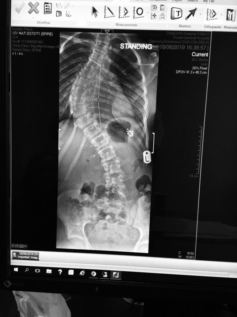 Idiopathic Scoliosis