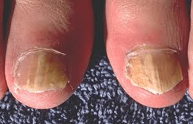 Brittle toe nails