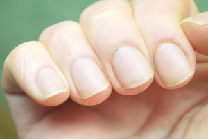 Nail bed injuries are the most common type of fingertip injuries seen in emergency rooms. Nails Problems
