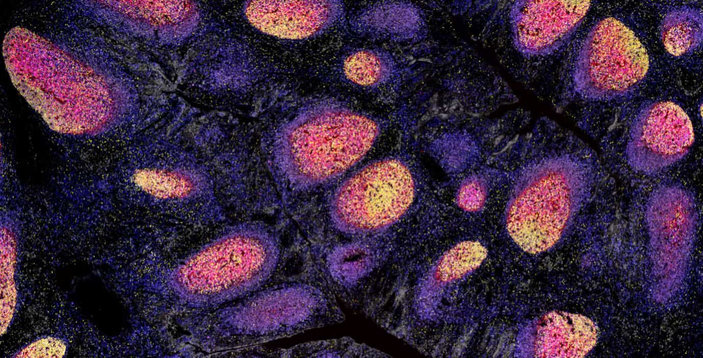 Research breakthrough set to personalise treatment for cancer, heart and lung disease