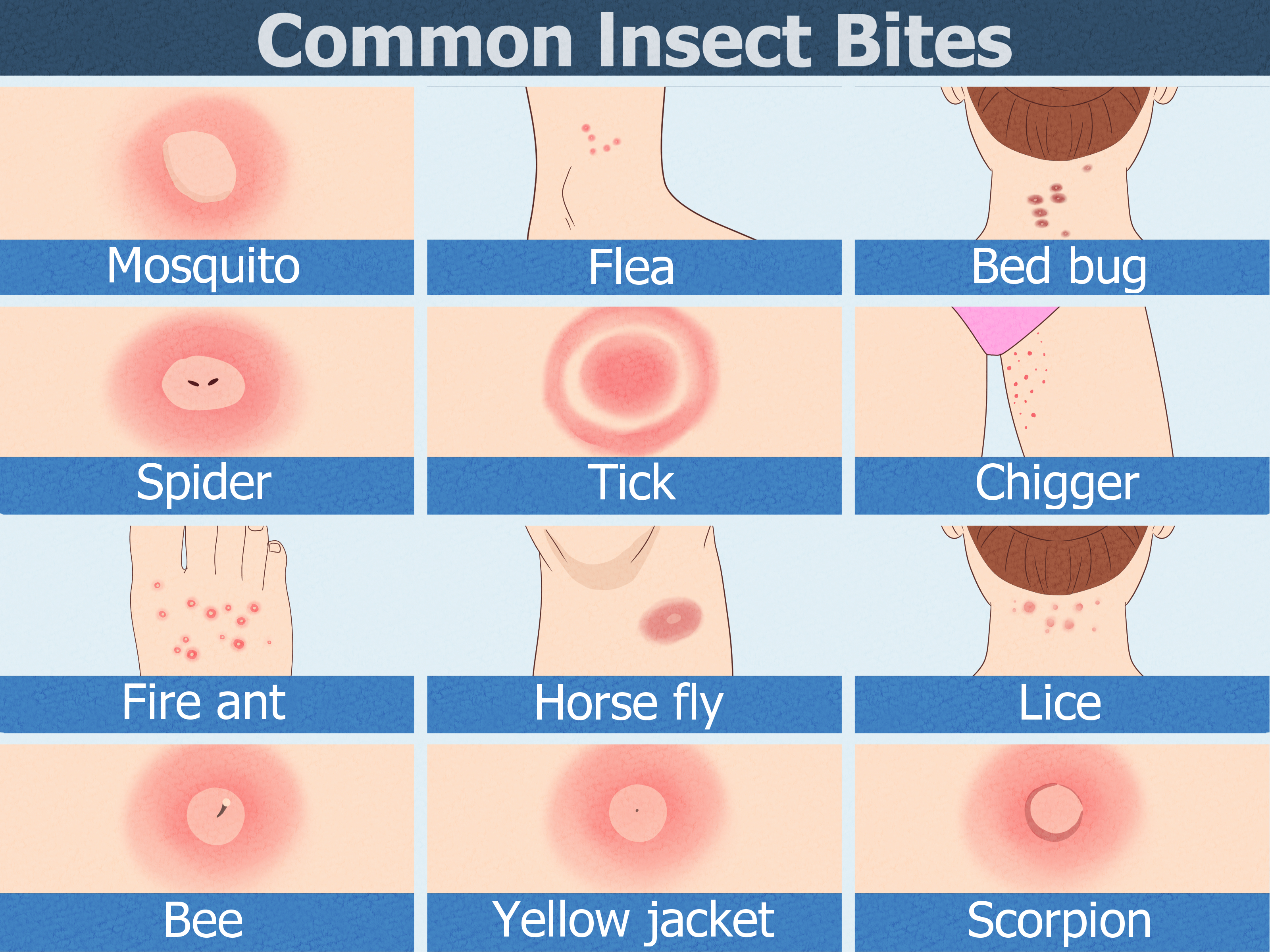 Insect bites treatment
