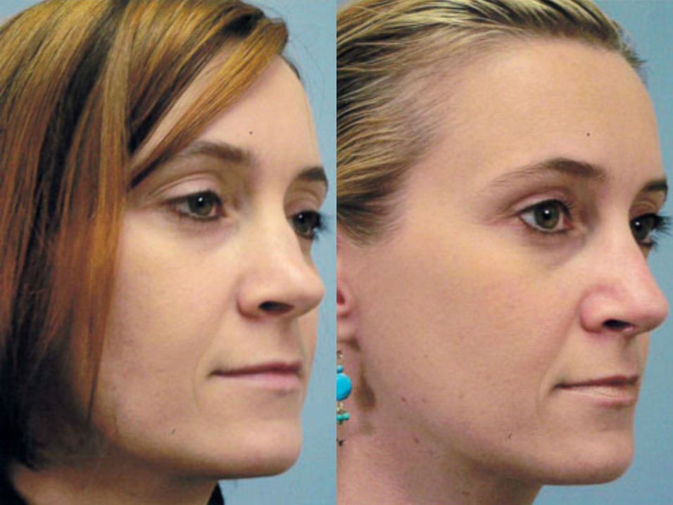 Saddle nose deformity from nasal fracture. Saddle Nose Rhinoplasty Surgery Williams Center Williams Center