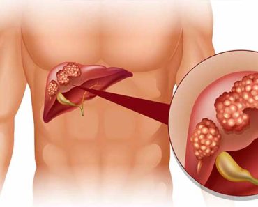 Alcohol Metabolism 