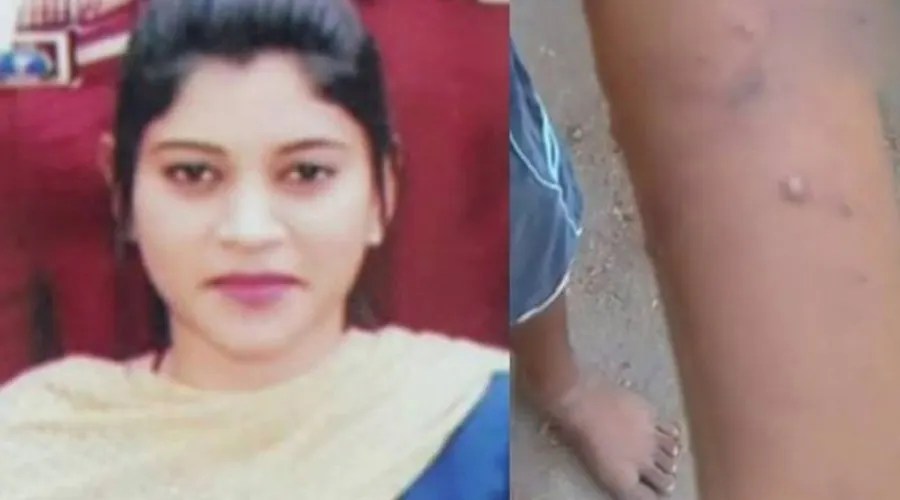 வீட்டு பாடம் செய்யாத மாணவன் கையில் சூடுவைத்த ஆசிரியை