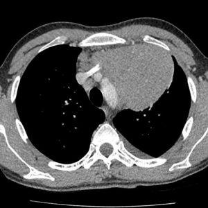 U trung thất * Xray.vn U trung thất * Xray.vn