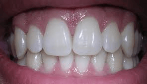VA Dental Care - photo of teeth