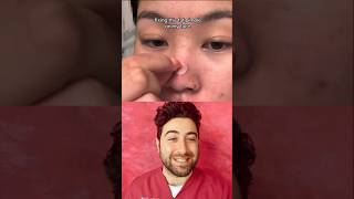 Treating NOSE ACNE with pimple patch