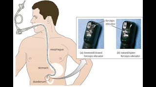Removal of foreign body by EGD CPT code - simplify medical coding