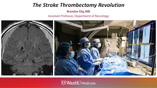 11-13-2025 - The Stroke Thrombectomy Revolution