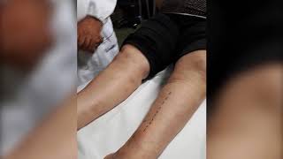 RECURRENT PHLEBITIS