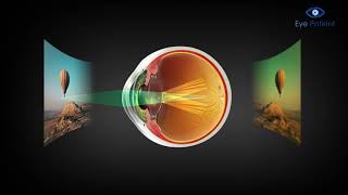 Cataract Overview | Free Eye Patient App