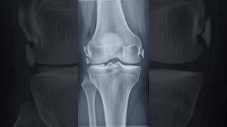 Knee. - CranioRachischisis