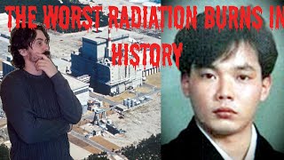 Hisashi Ouchi, The Man Who Suffered The Worst Radiation Burns In History