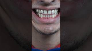 My Full Braces Journey&hellip; so far 😁