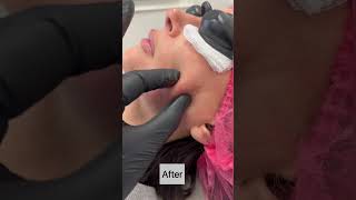 Endolift skin tigtening treatment #endolift #endoliftreview