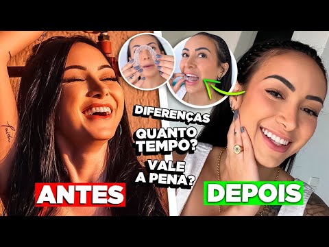 Finalizei meu tratamento com os alinhadores da SouSmile - VALEU &Agrave; PENA MESMO?