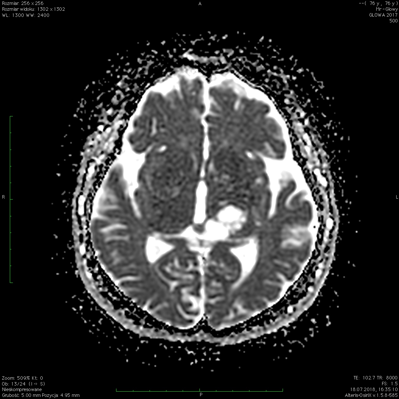 Apparent Diffusion Coefficient