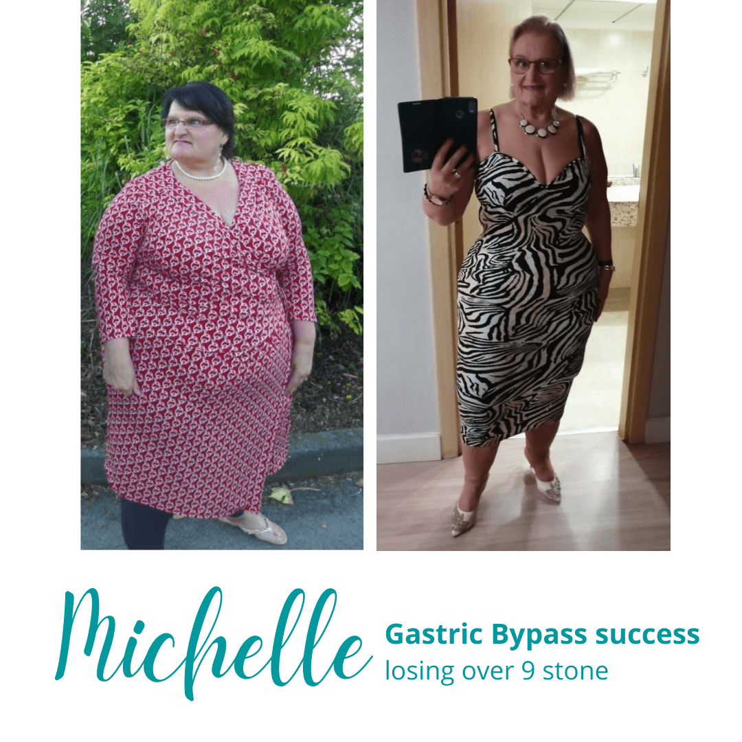 Michelle's Gastric Bypass Success