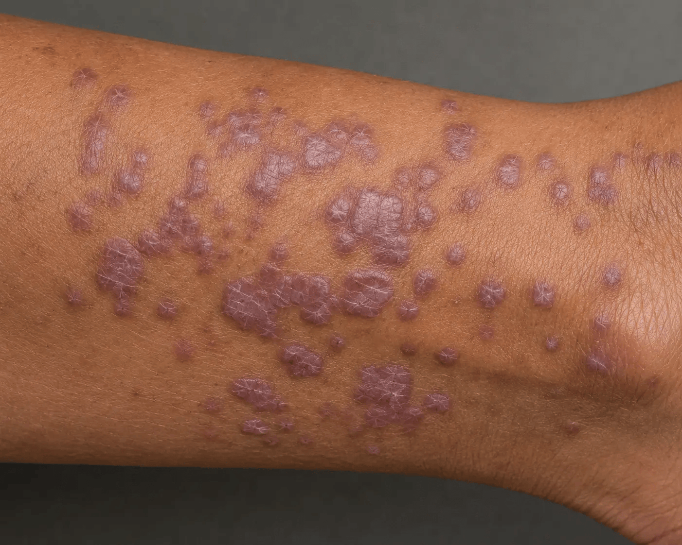 Lichen Planus.webp